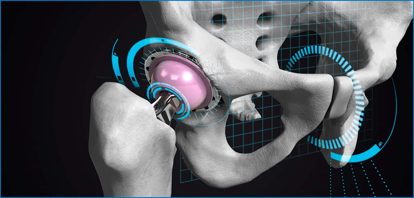 Minimal-invasive Endoprothetik